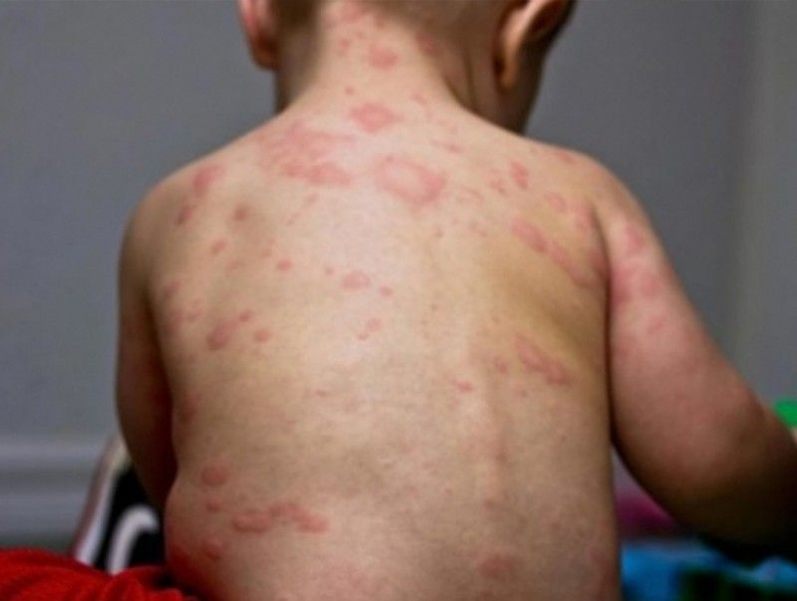 Менингококкт халдварын тохиолдол хоёр аймагт бүртгэгджээ