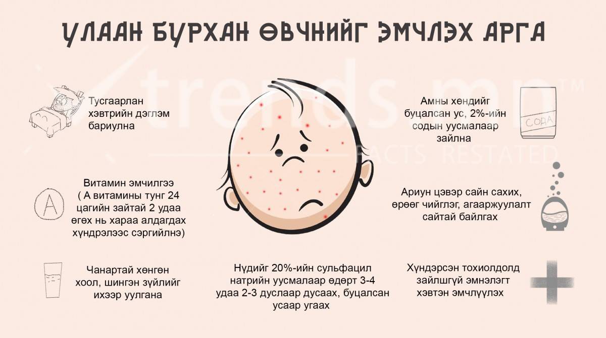 Улаанбурхан өвчинг гэрээр эмчлэх арга