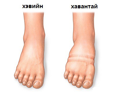 Зөвлөгөө: Хавагнахаас хэрхэн урьдчилан сэргийлэх вэ